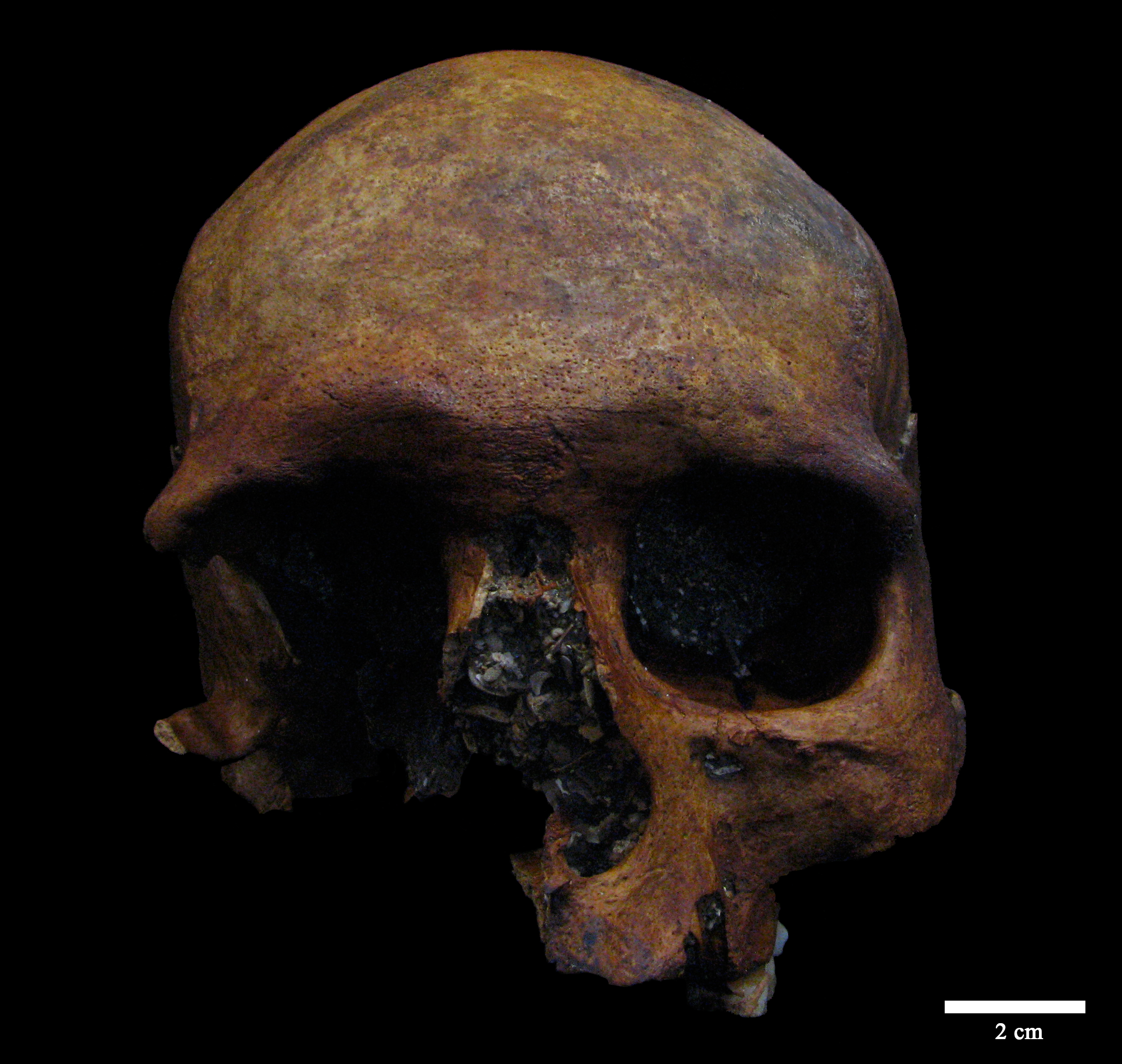 tumor craneal de época romana